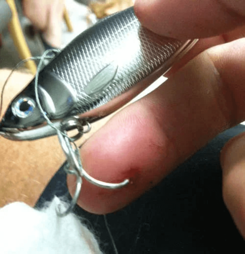 Fish Hooks What To Do If You Get One Stuck In Your Finger